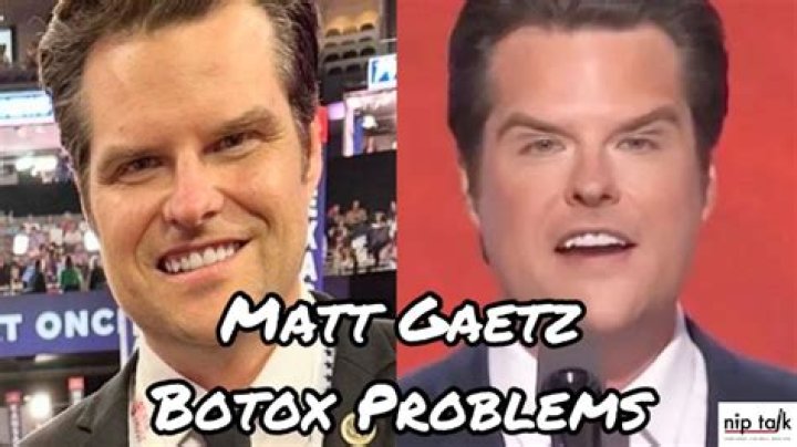 Matt Gaetz Botox Before and After: A Comprehensive Analysis